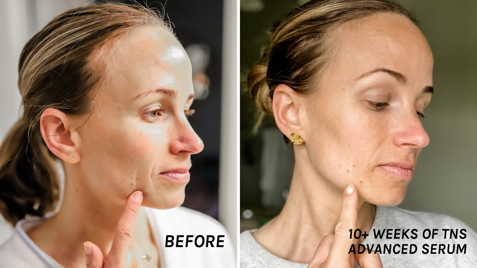 TeriLyn Adams showing skin before and after using SkinMedica TNS Advanced Serum
