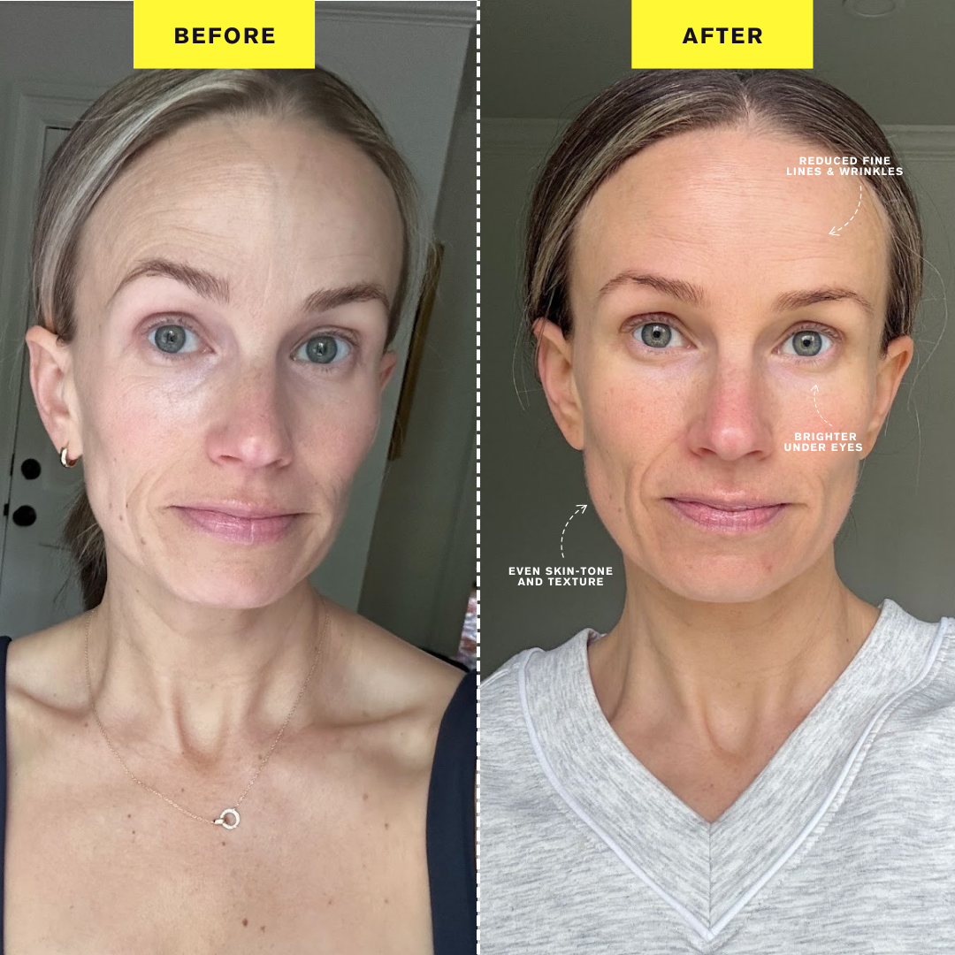 Before and after pictures of TeriLyn Adams face after using the ZIIP Halo for 30 days